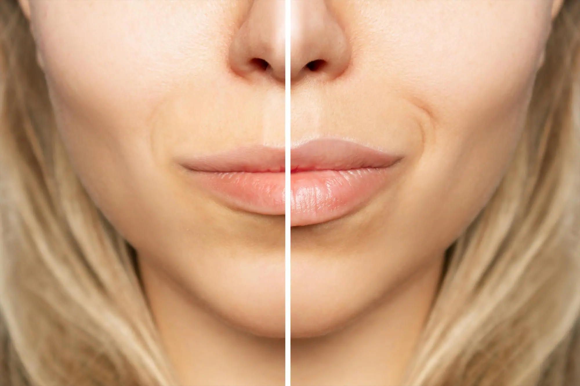 upper lip lift without surgery