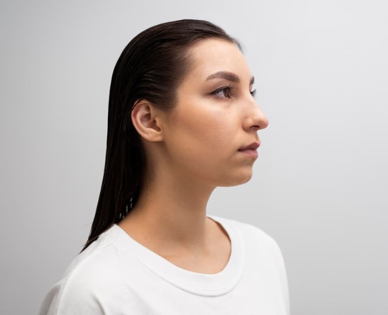 Am I Suitable for Rhinoplasty?