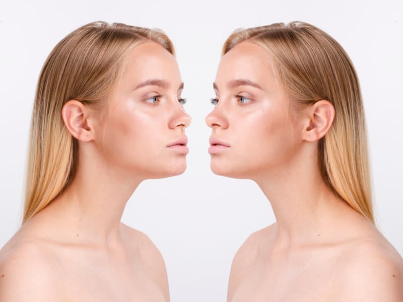 What Are the Advantages of Nose Tip Lift with Botox