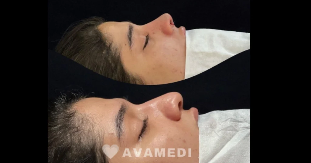 Bulbous Nose Rhinoplasty before and after by Dr Hamidreza Hosnani 